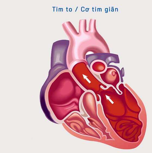 Hình minh họa tim to và cơ tim giãn do bệnh Parvo ở chó.